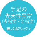 手足の先天異常 (多指症・合指症)