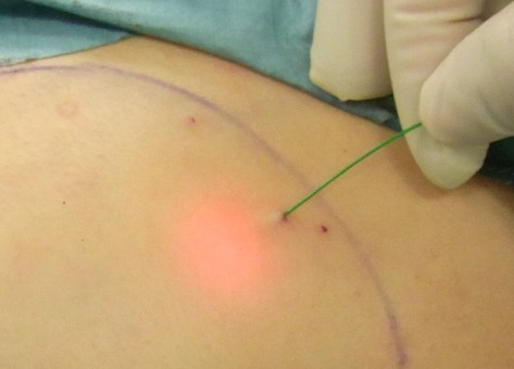 胸部の静脈先天異常におけるレーザー照射治療写真
