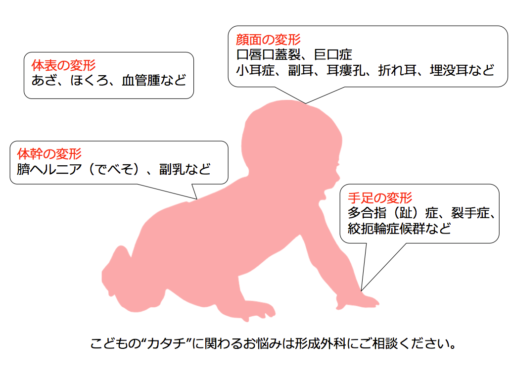 先天異常 和歌山県立医科大学付属病院形成外科公式サイト